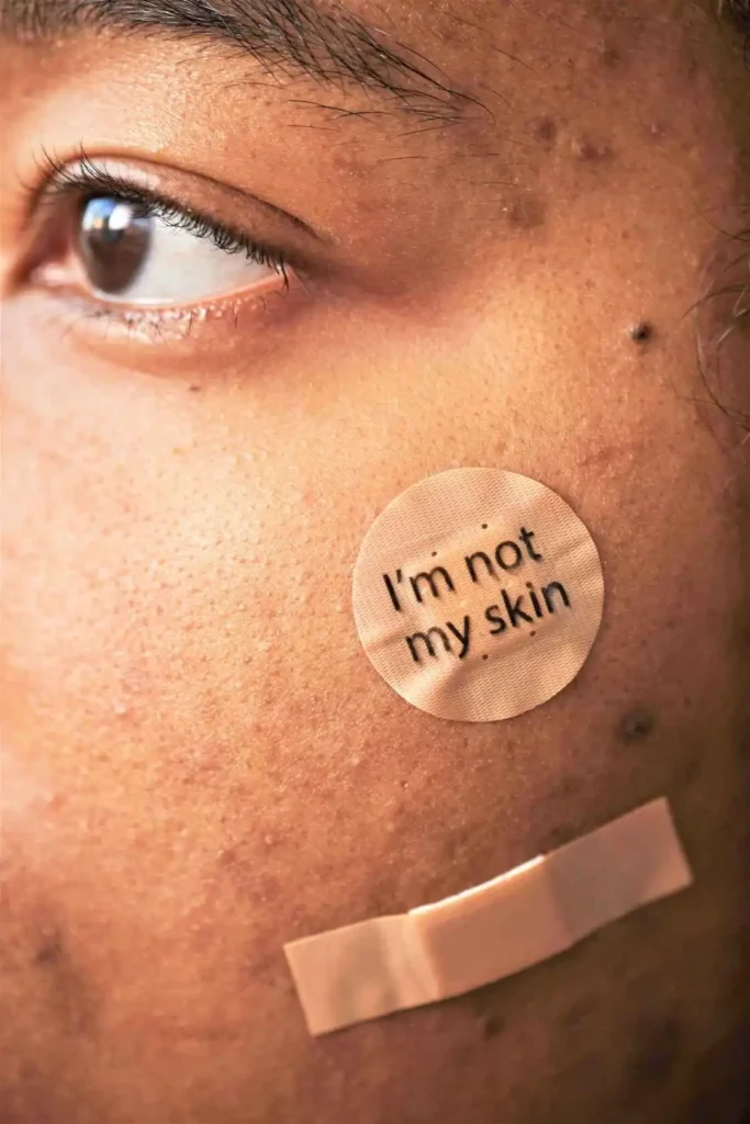 9.-Good-mental-health-leads-to-acne-free-skin